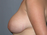 Patient # 48277 Before Photo # 5